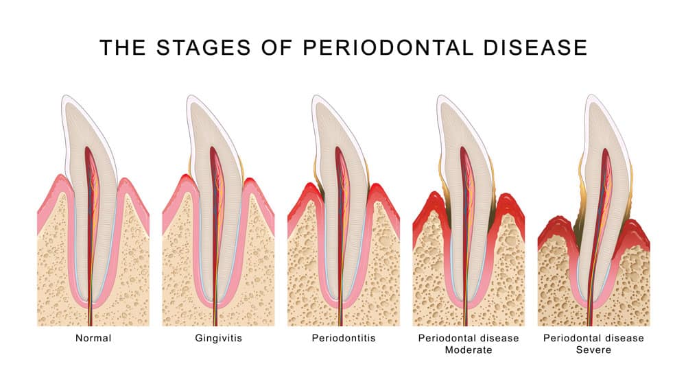 Preventive Measures For Periodontal Health And Deep Cleaning Excellence