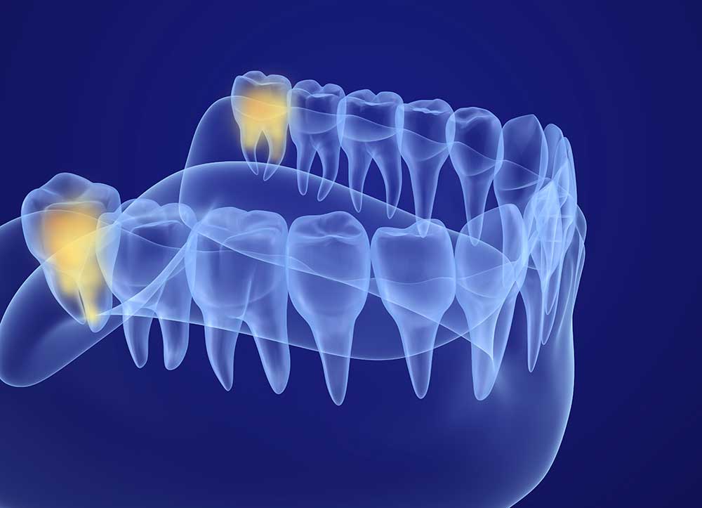 Wisdom Teeth Removal & Extraction Near Bowmanville