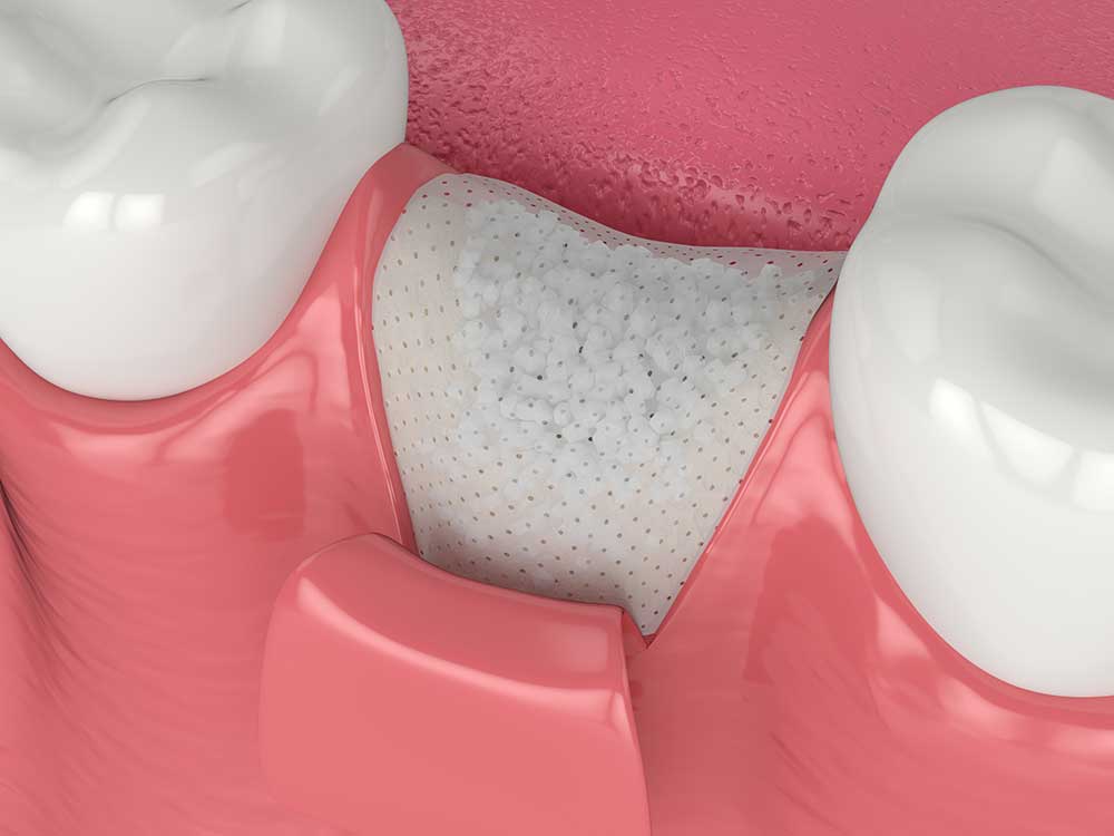 Tooth Implants Bowmanville, ON