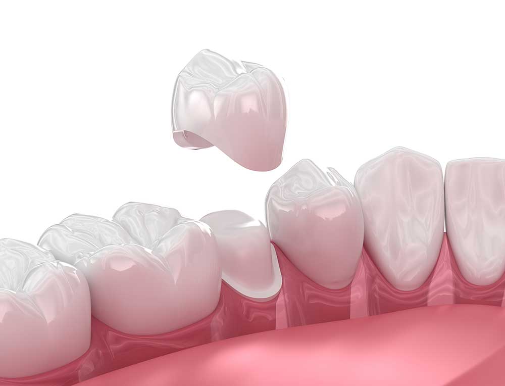Dental Crown Procedures