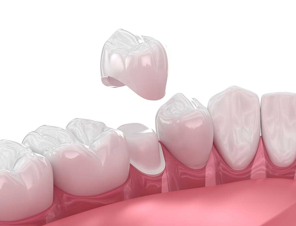 Dental Crown Procedures