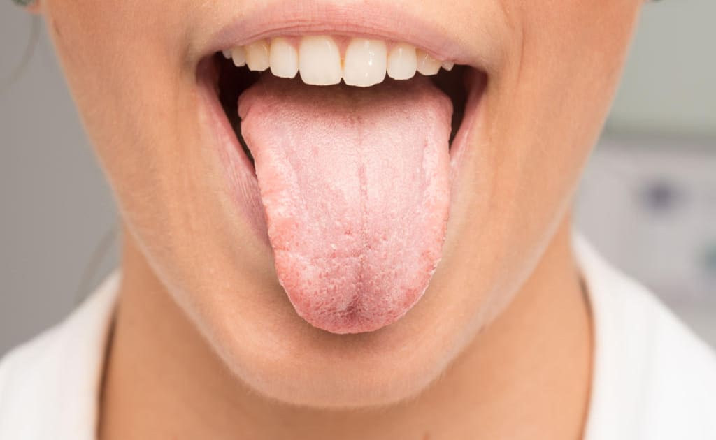 dry-mouth-xerostomia