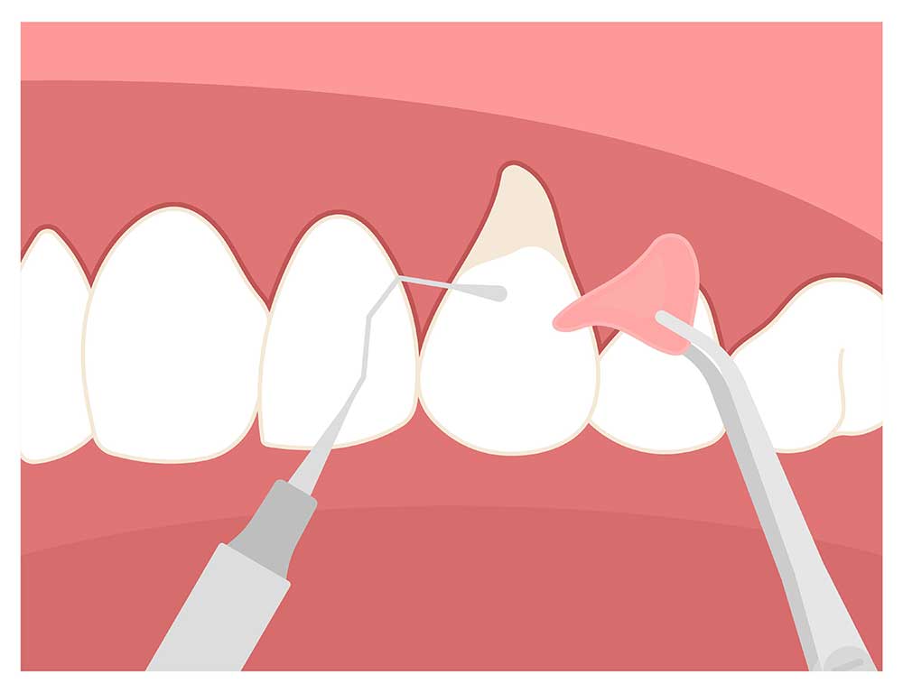 Gum Grafting Restoring