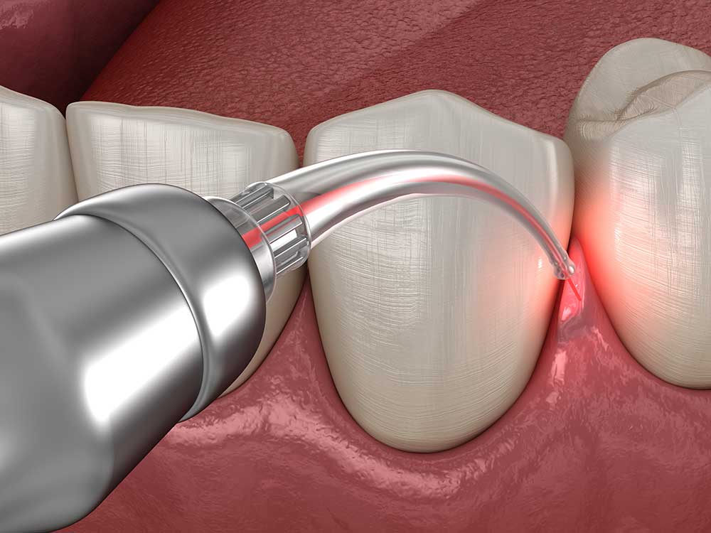 Transforming Gummy Smiles With Gum Contouring Surgery