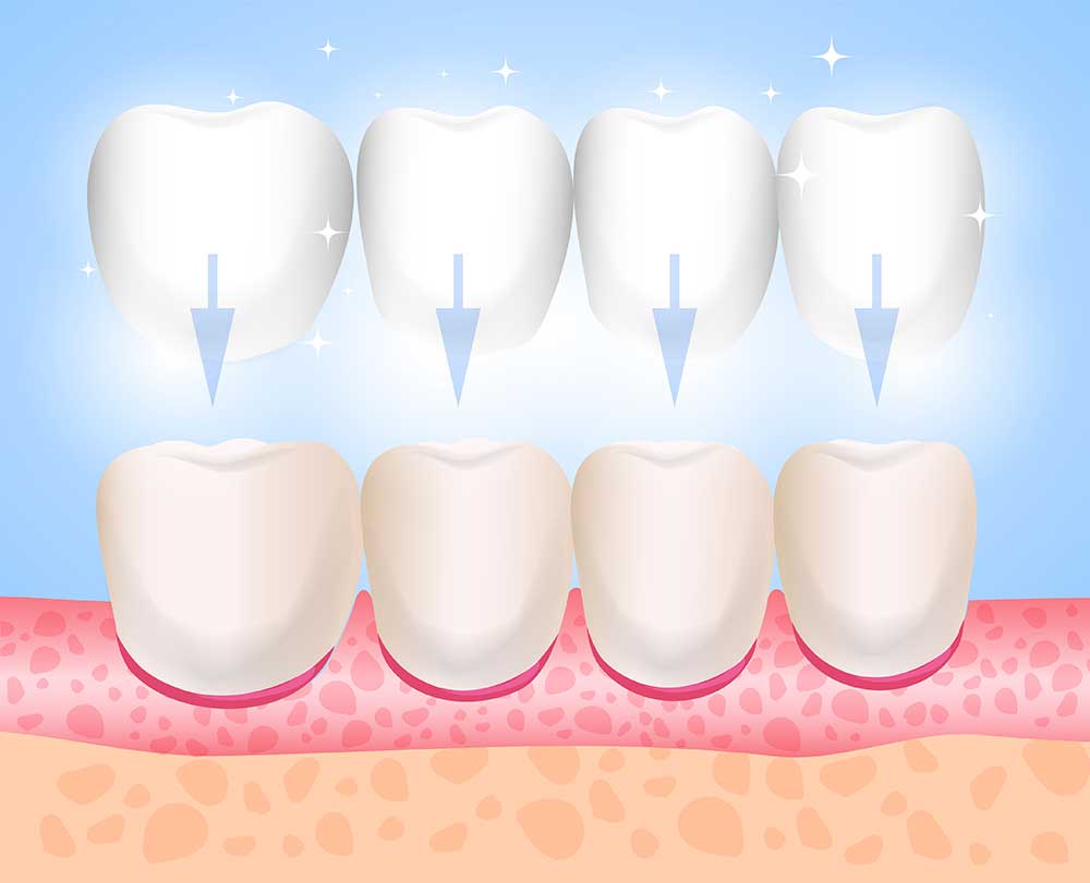 Lumineers attach to the front of your teeth