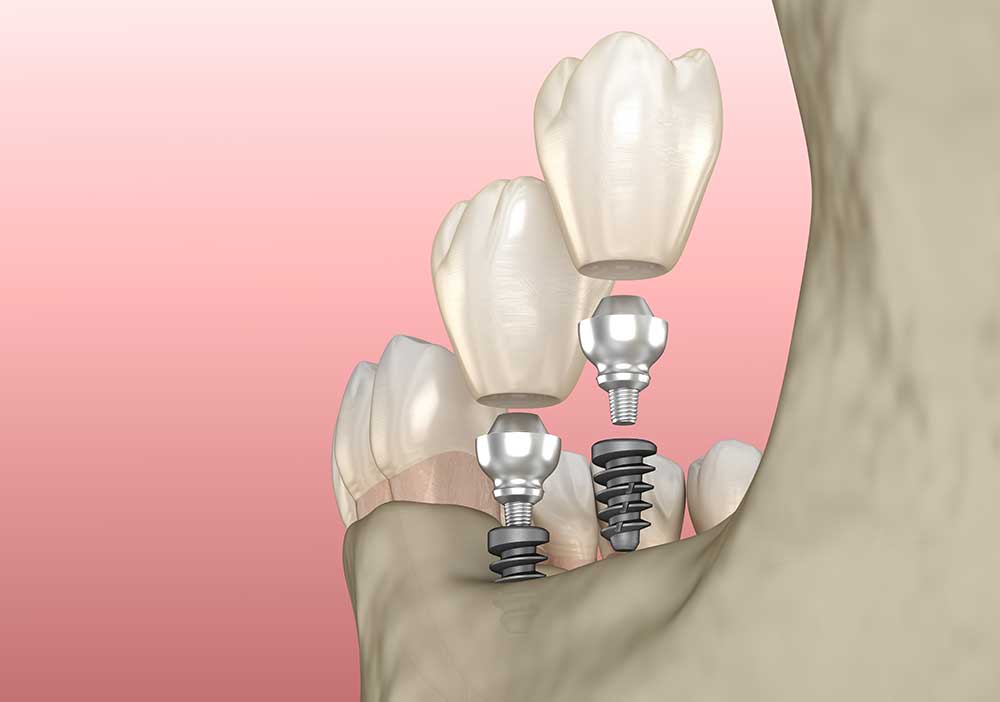 Affordable Dental Implants in Bowmanville