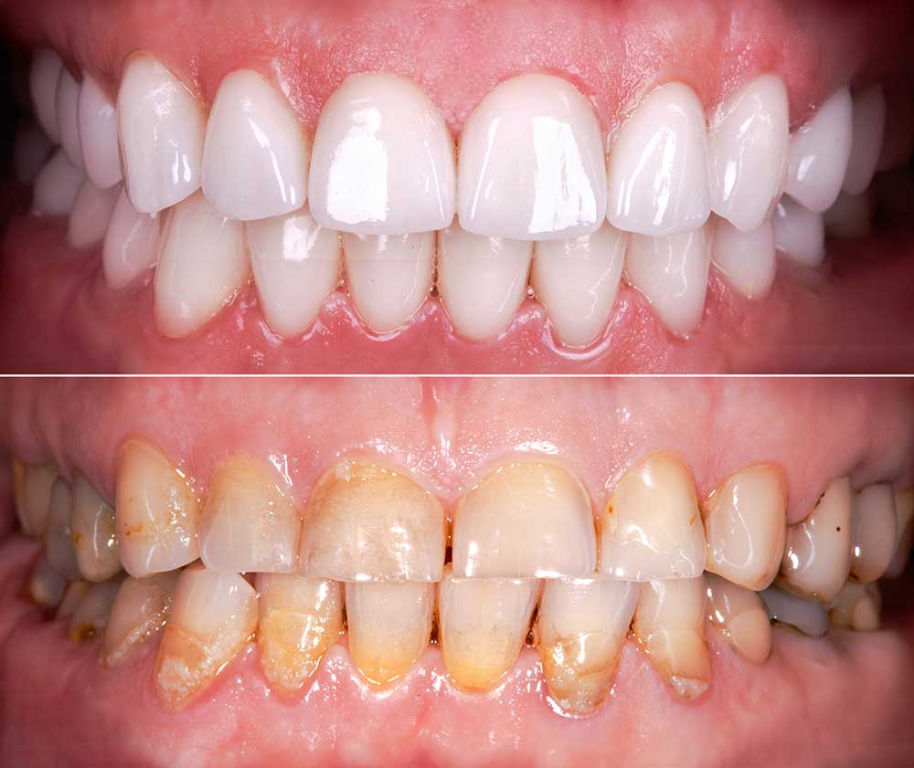 Veneers For A Natural, Healthy, And Youthful Look
