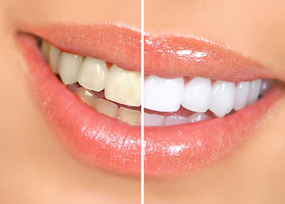 Zoom! Teeth Whitening Near Me